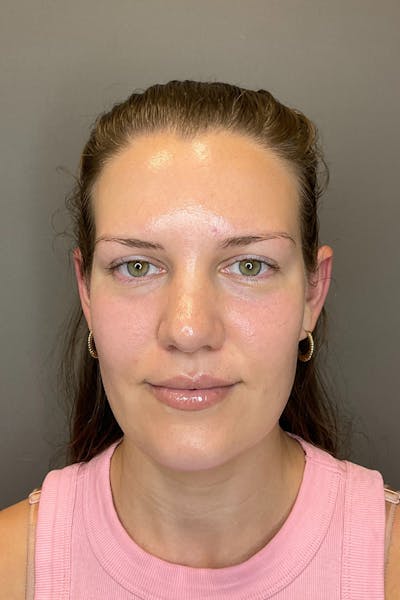 Hydrafacial Before & After Gallery - Patient 128836 - Image 2