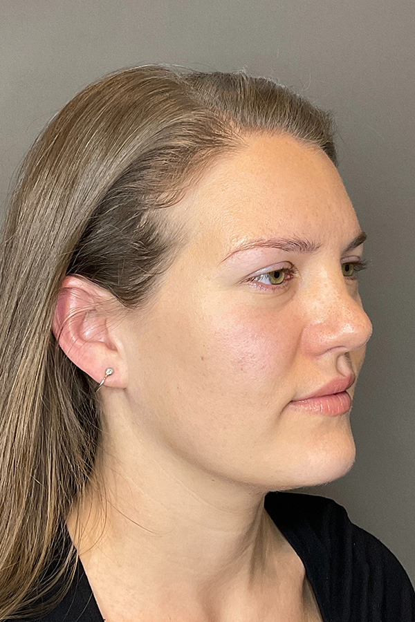 Hydrafacial Before & After Gallery - Patient 128836 - Image 3