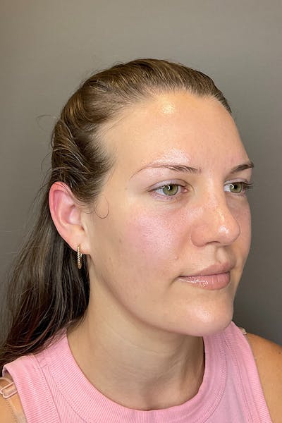 Hydrafacial Before & After Gallery - Patient 128836 - Image 4