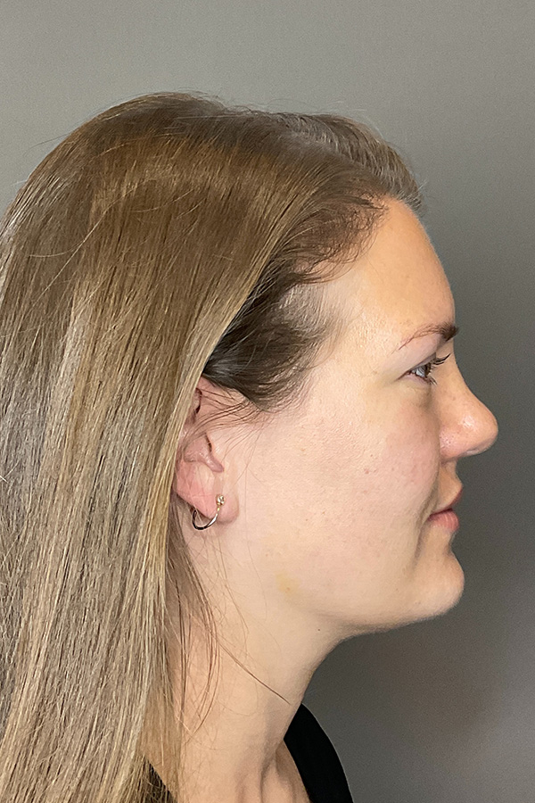 Hydrafacial Before & After Gallery - Patient 128836 - Image 5