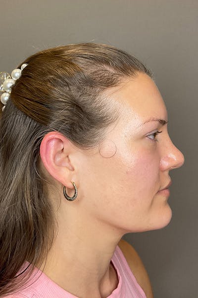 Hydrafacial Before & After Gallery - Patient 128836 - Image 6