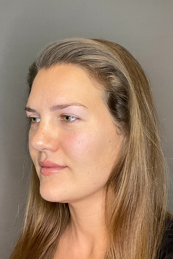 Hydrafacial Before & After Gallery - Patient 128836 - Image 7