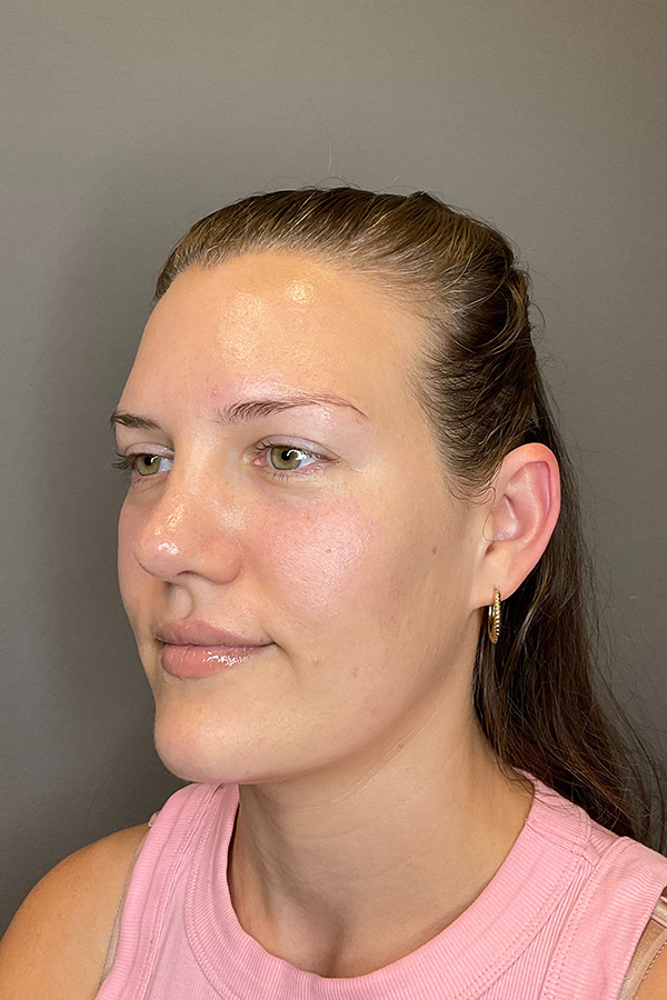 Hydrafacial Before & After Gallery - Patient 128836 - Image 8