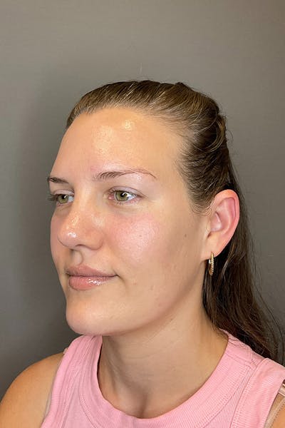 Hydrafacial Before & After Gallery - Patient 128836 - Image 8