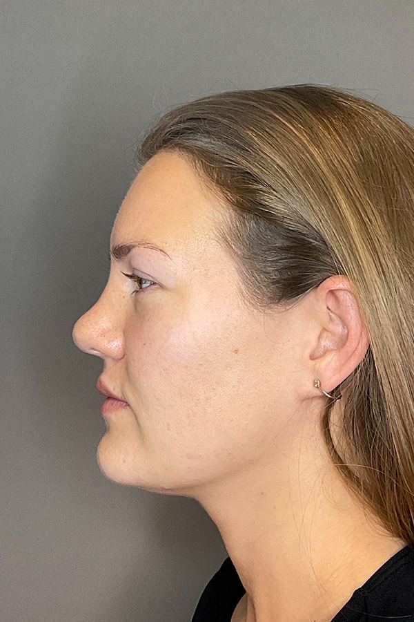 Hydrafacial Before & After Gallery - Patient 128836 - Image 9