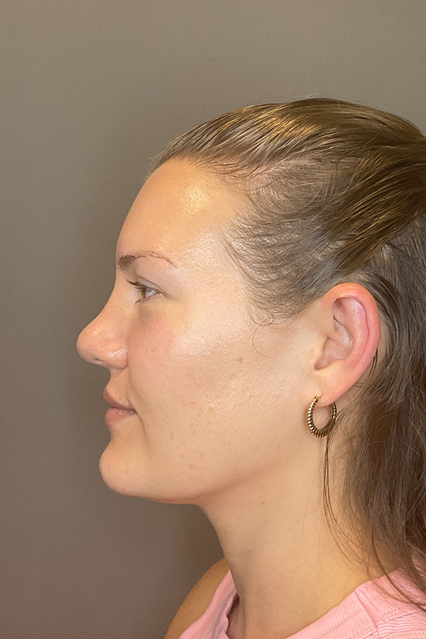 Hydrafacial Before & After Gallery - Patient 128836 - Image 10