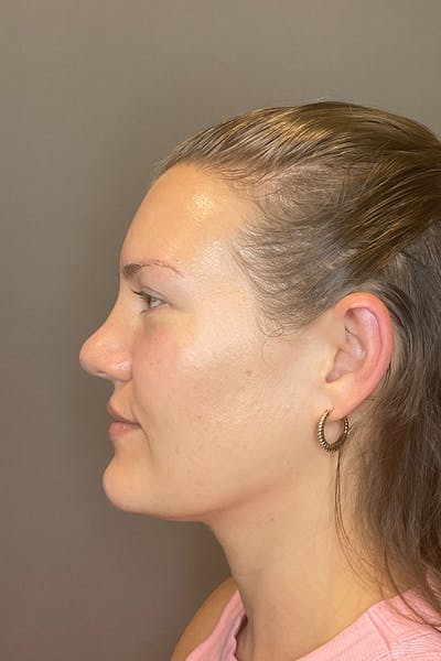 Hydrafacial Before & After Gallery - Patient 128836 - Image 10