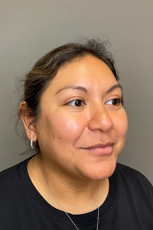 Hydrafacial Before & After Gallery - Patient 146401 - Image 3