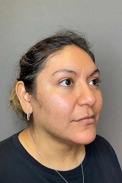 Hydrafacial Before & After Gallery - Patient 146401 - Image 4