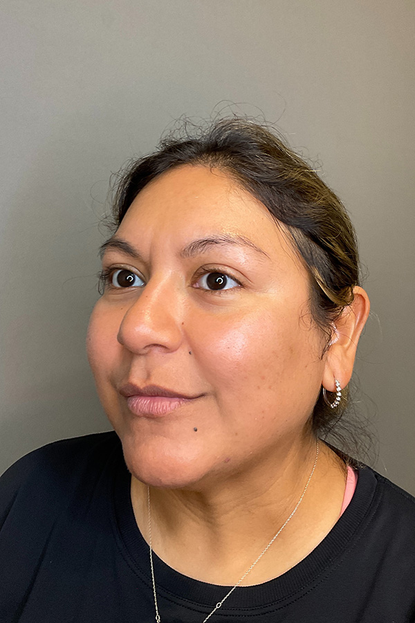 Hydrafacial Before & After Gallery - Patient 146401 - Image 5