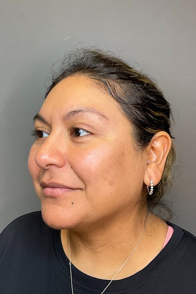 Hydrafacial Before & After Gallery - Patient 146401 - Image 6