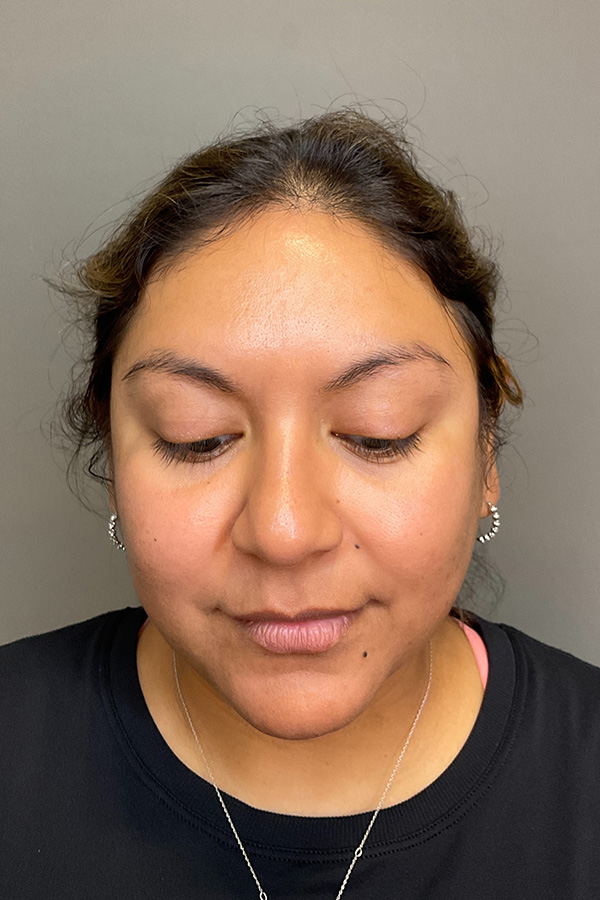 Hydrafacial Before & After Gallery - Patient 146401 - Image 7