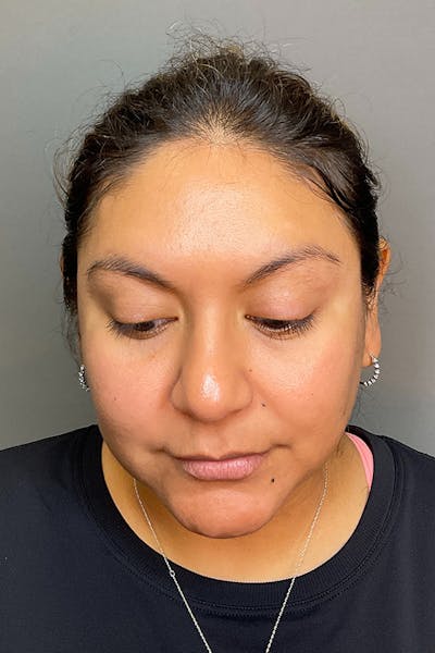 Hydrafacial Before & After Gallery - Patient 146401 - Image 8