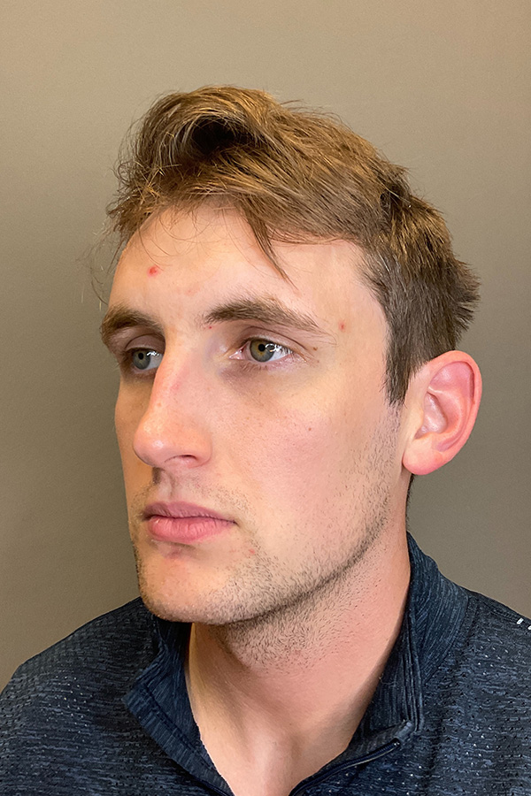 Hydrafacial Before & After Gallery - Patient 182878 - Image 3
