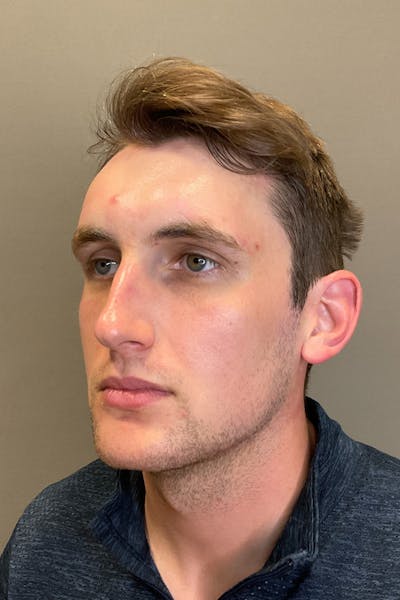 Hydrafacial Before & After Gallery - Patient 182878 - Image 4