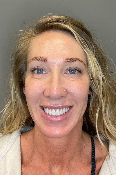Laser Skin Resufacing Before & After Gallery - Patient 496572 - Image 2