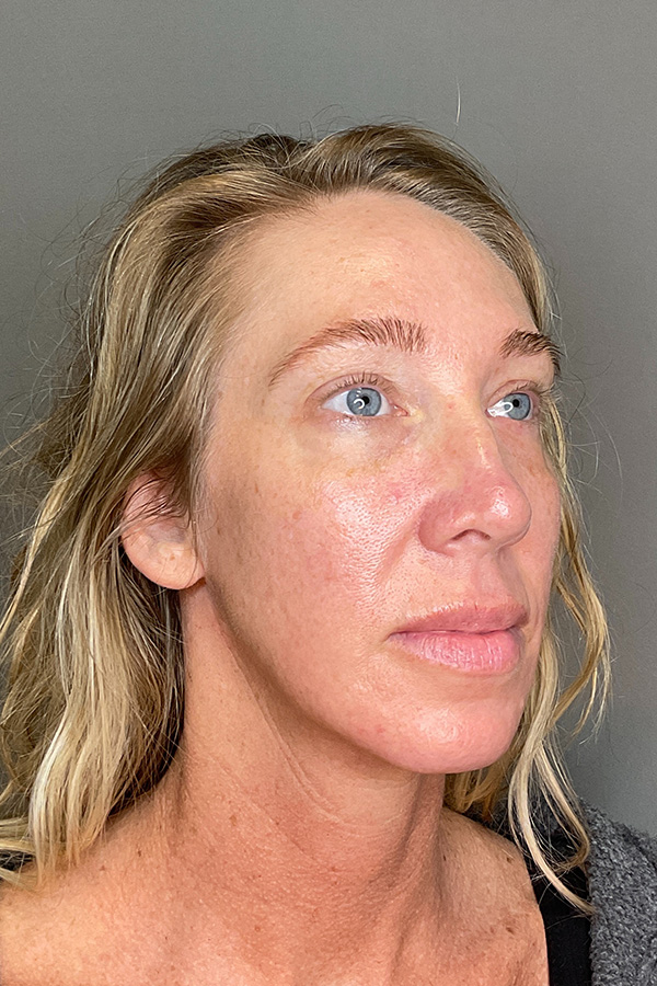 Laser Skin Resufacing Before & After Gallery - Patient 496572 - Image 3