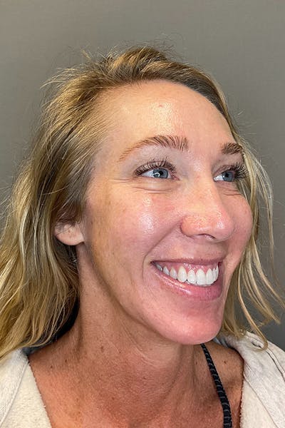 Laser Skin Resufacing Before & After Gallery - Patient 496572 - Image 4