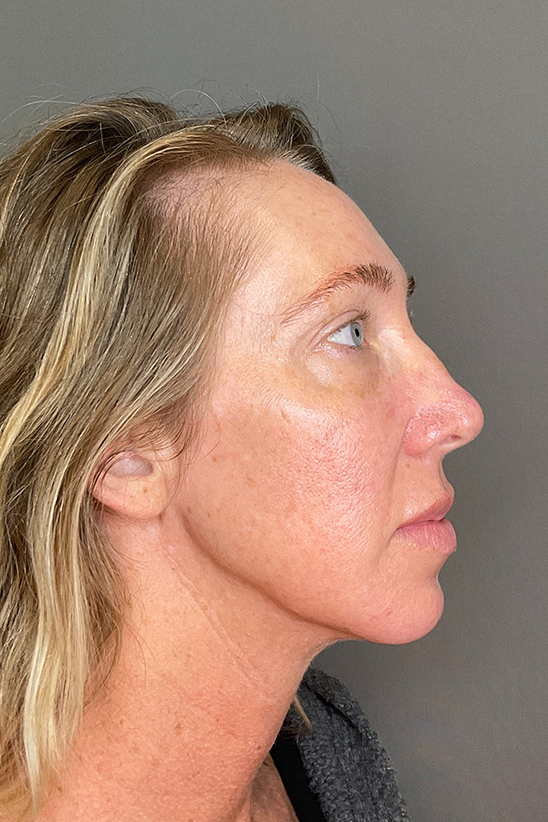 Laser Skin Resufacing Before & After Gallery - Patient 496572 - Image 5
