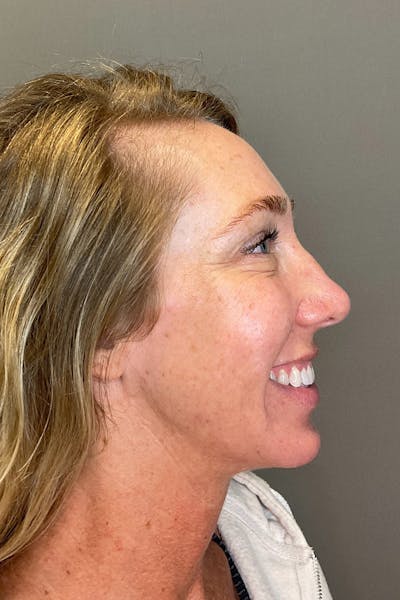 Laser Skin Resufacing Before & After Gallery - Patient 496572 - Image 6