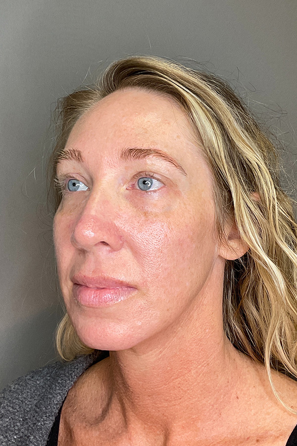 Laser Skin Resufacing Before & After Gallery - Patient 496572 - Image 7