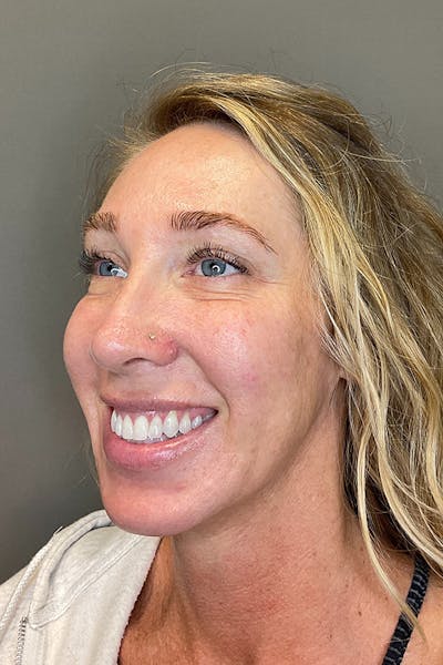 Laser Skin Resufacing Before & After Gallery - Patient 496572 - Image 8