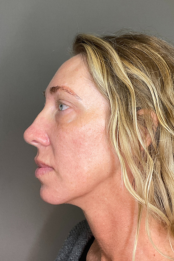 Laser Skin Resufacing Before & After Gallery - Patient 496572 - Image 9