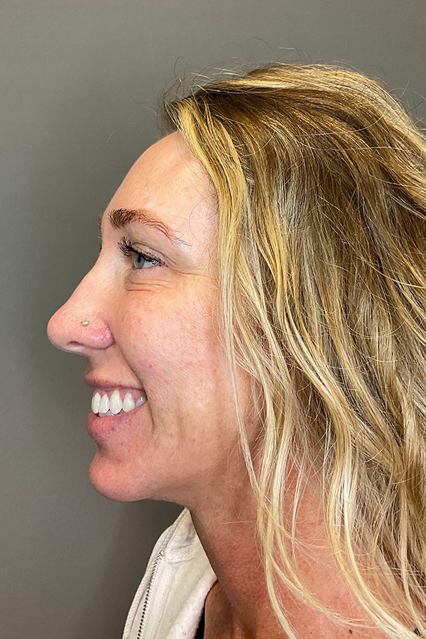 Laser Skin Resufacing Before & After Gallery - Patient 496572 - Image 10