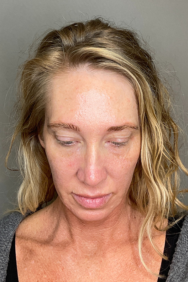 Laser Skin Resufacing Before & After Gallery - Patient 496572 - Image 11