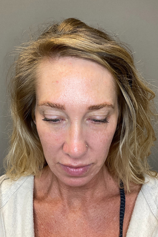 Laser Skin Resufacing Before & After Gallery - Patient 496572 - Image 12
