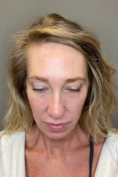 Laser Skin Resufacing Before & After Gallery - Patient 496572 - Image 12