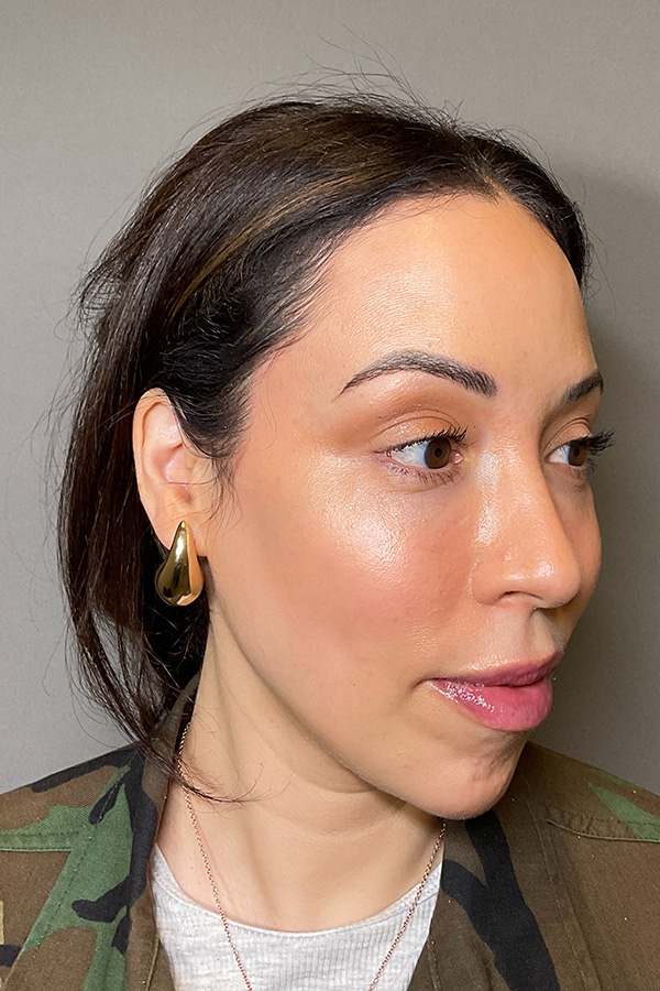Laser Skin Resufacing Before & After Gallery - Patient 138471 - Image 3