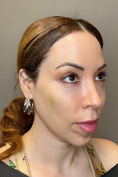 Laser Skin Resufacing Before & After Gallery - Patient 138471 - Image 4