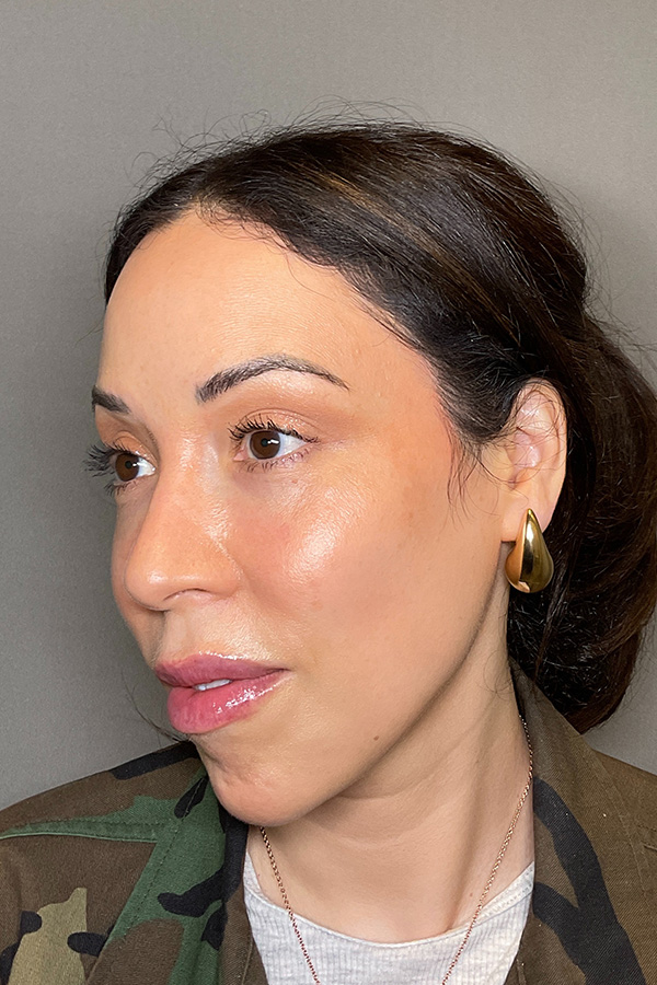 Laser Skin Resufacing Before & After Gallery - Patient 138471 - Image 7