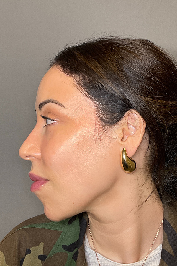 Laser Skin Resufacing Before & After Gallery - Patient 138471 - Image 9