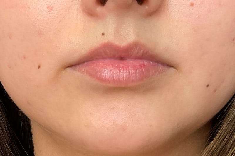 Lip Fillers Before & After Gallery - Patient 402769 - Image 1
