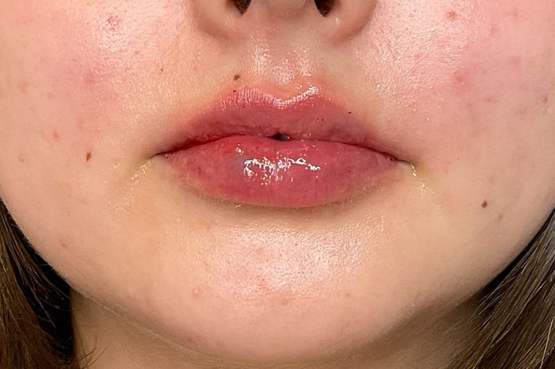 Lip Fillers Before & After Gallery - Patient 402769 - Image 2