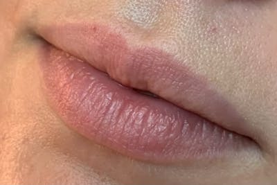 Lip Fillers Before & After Gallery - Patient 153862 - Image 1