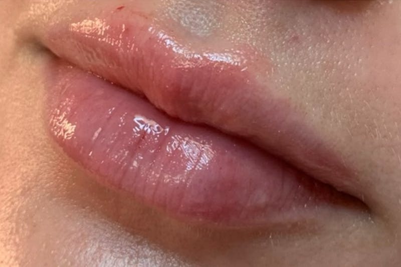 Lip Fillers Before & After Gallery - Patient 153862 - Image 2