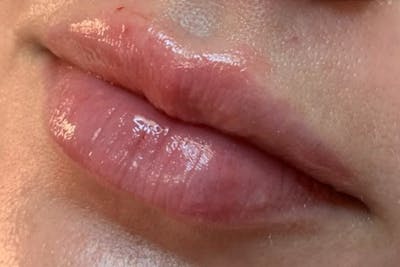 Lip Fillers Before & After Gallery - Patient 153862 - Image 2