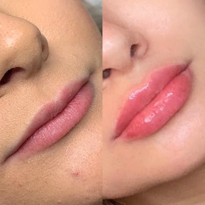 Lip Fillers Before & After Gallery - Patient 205070 - Image 1