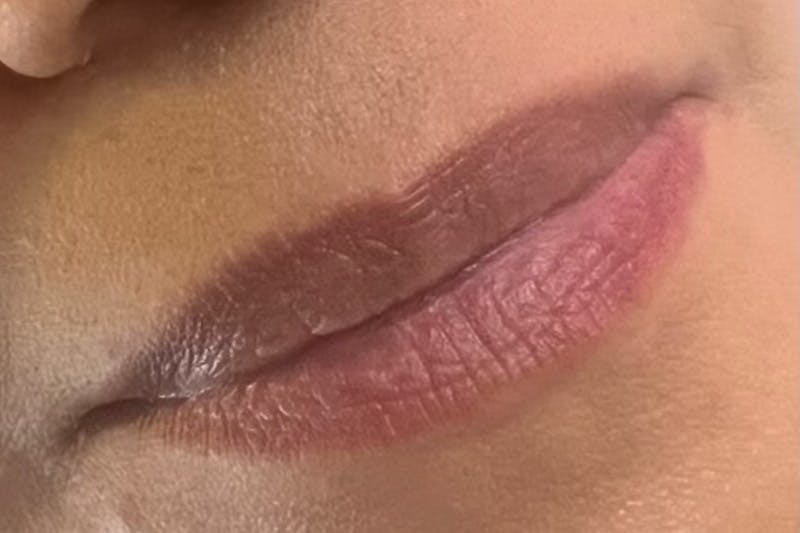 Lip Fillers Before & After Gallery - Patient 212024 - Image 1