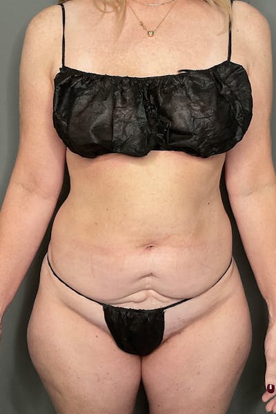 Liposuction Before & After Gallery - Patient 577698 - Image 1