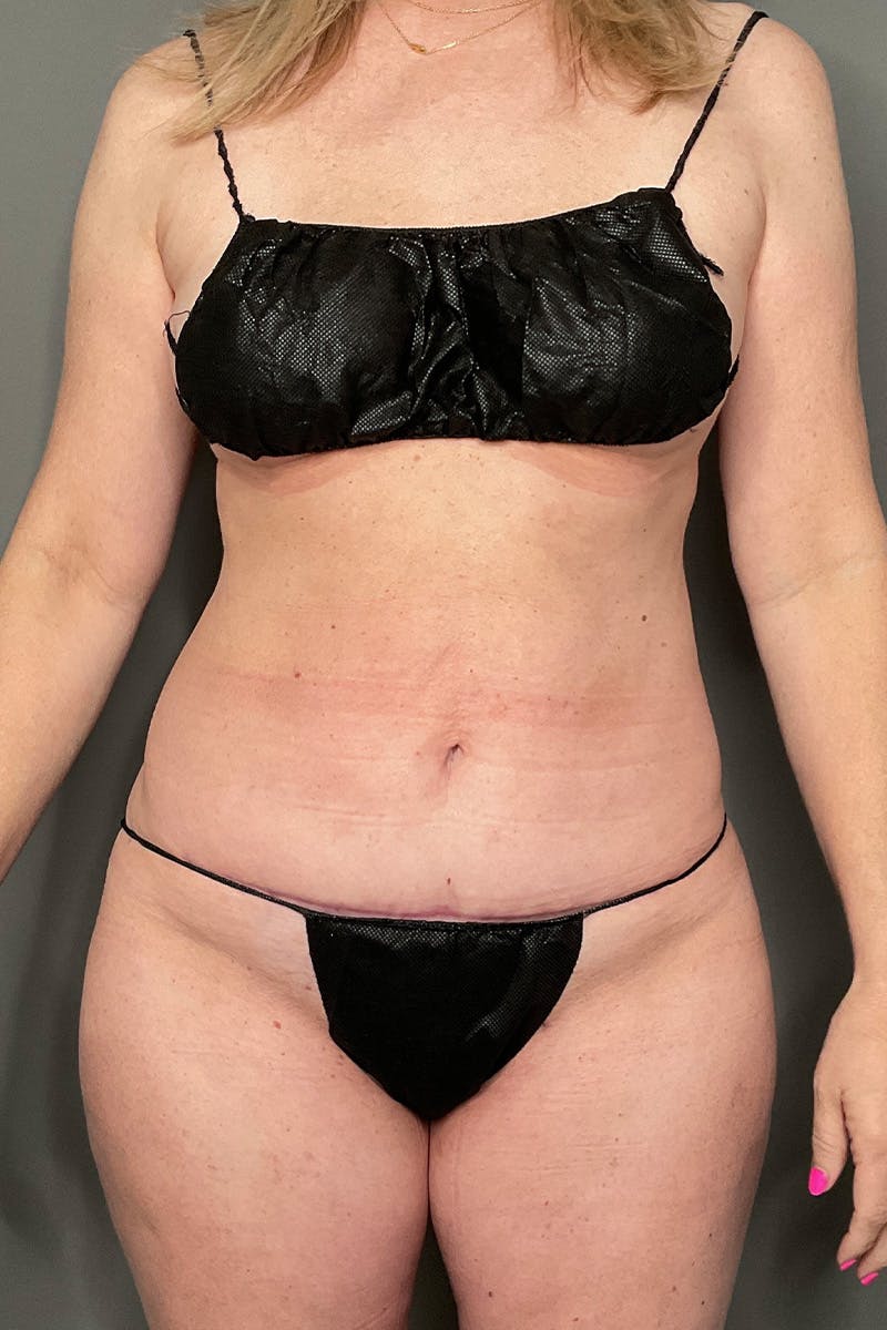 Liposuction Before & After Gallery - Patient 577698 - Image 2
