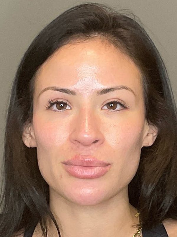 Sciton Before & After Gallery - Patient 222895 - Image 1