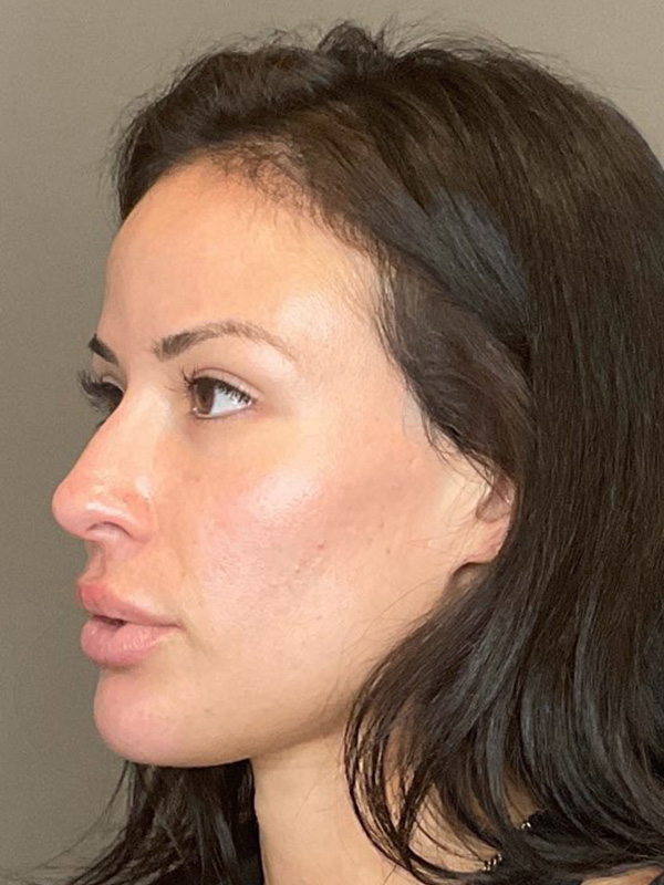 Sciton Before & After Gallery - Patient 222895 - Image 3