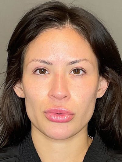 Sciton Before & After Gallery - Patient 222895 - Image 2