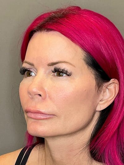 Sciton Before & After Gallery - Patient 354432 - Image 2
