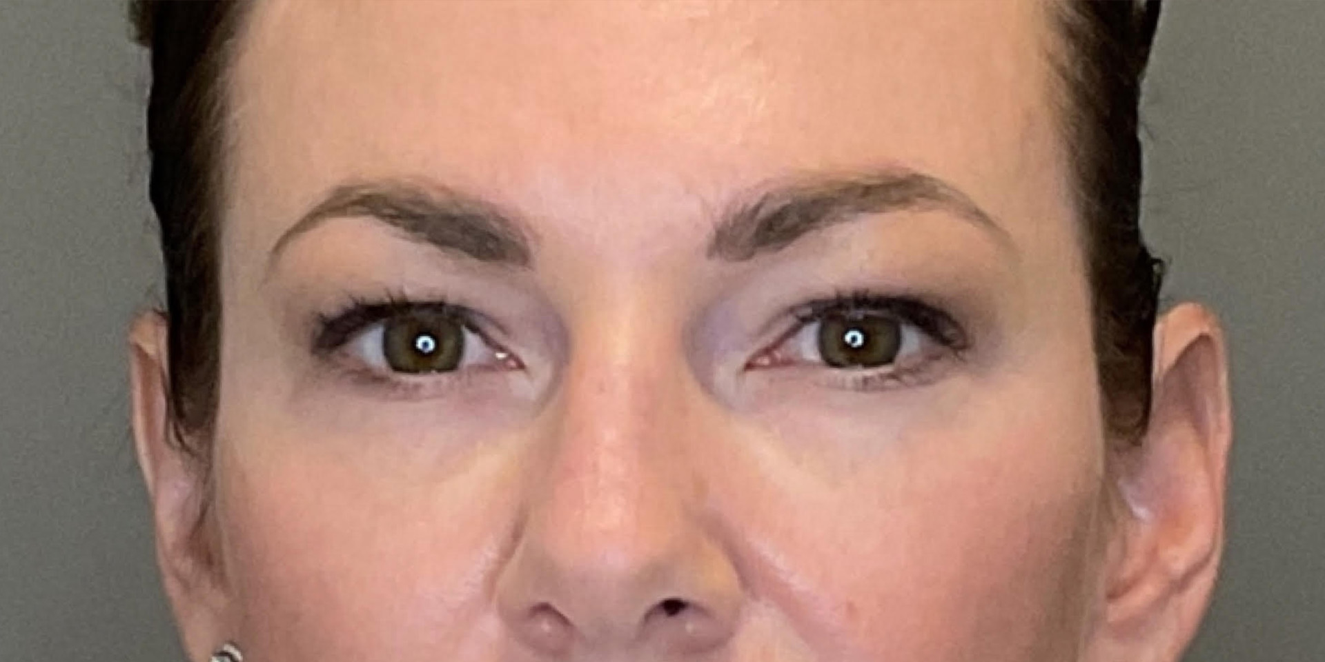 PDGF Before & After Gallery - Patient 258676 - Image 1