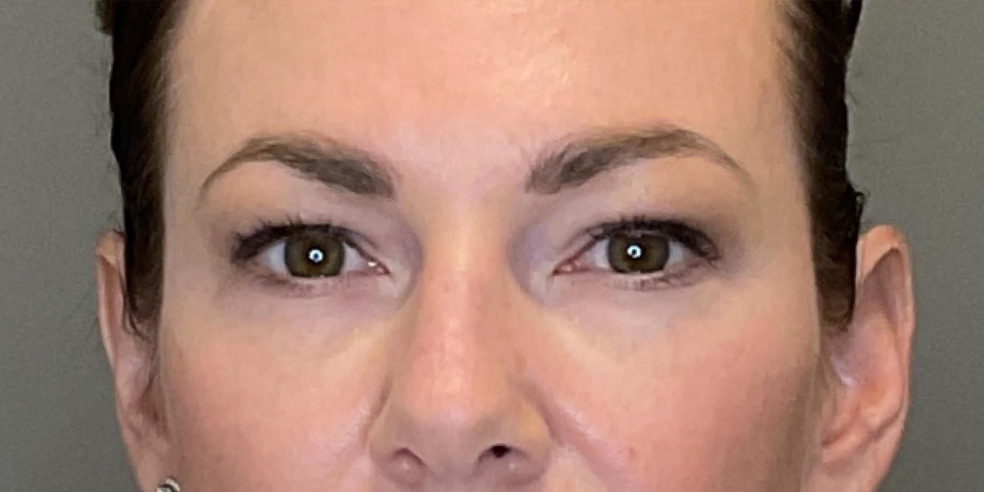 PDGF Before & After Gallery - Patient 258676 - Image 1